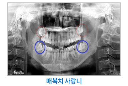 매복치사랑니